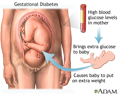 Women Who Experience Gestational Diabetes: Understanding, Managing, and Preventing Risks