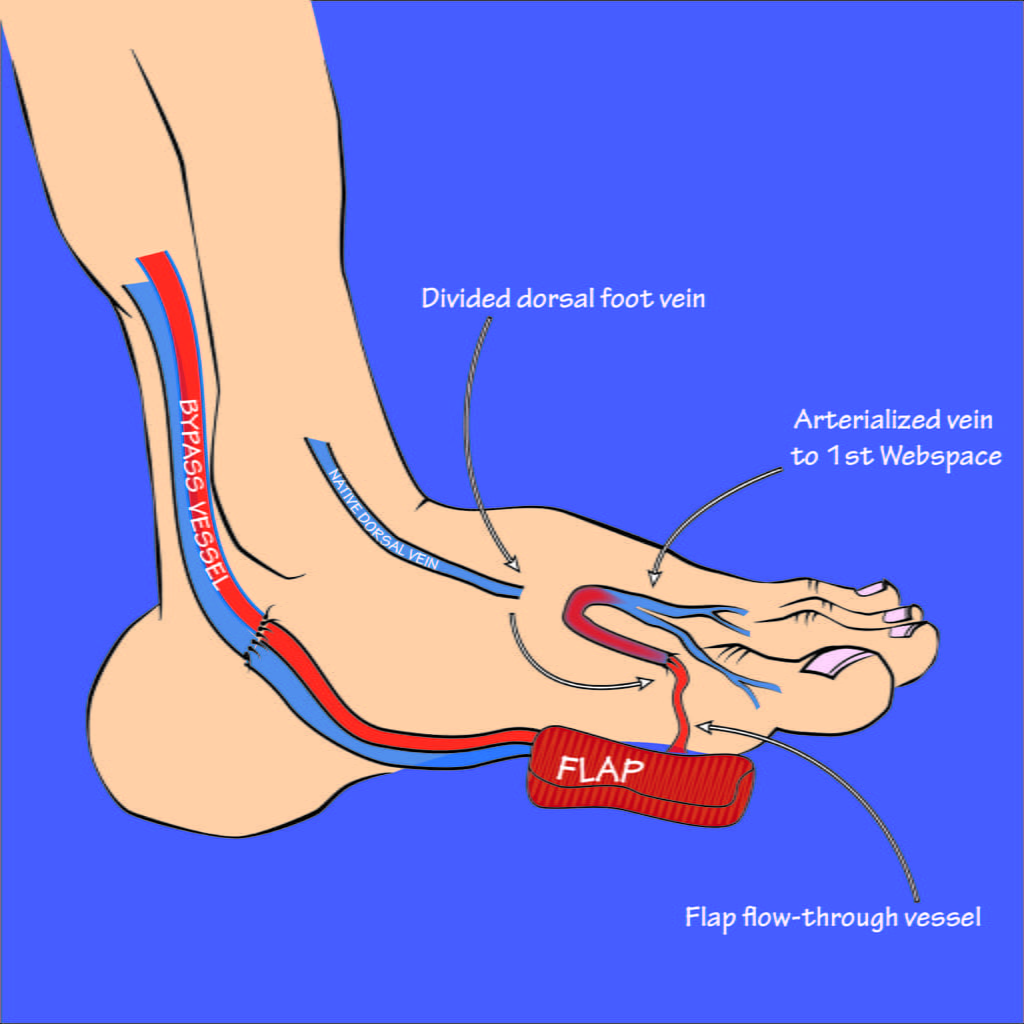Plumber’s Infection Leads to Leg Amputation: A Warning